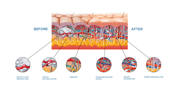 X-Wave Treatment Johor Bahru l Lyvin Clinic 